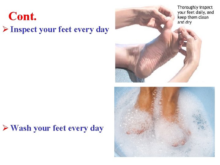 Cont. Ø Inspect your feet every day Ø Wash your feet every day 