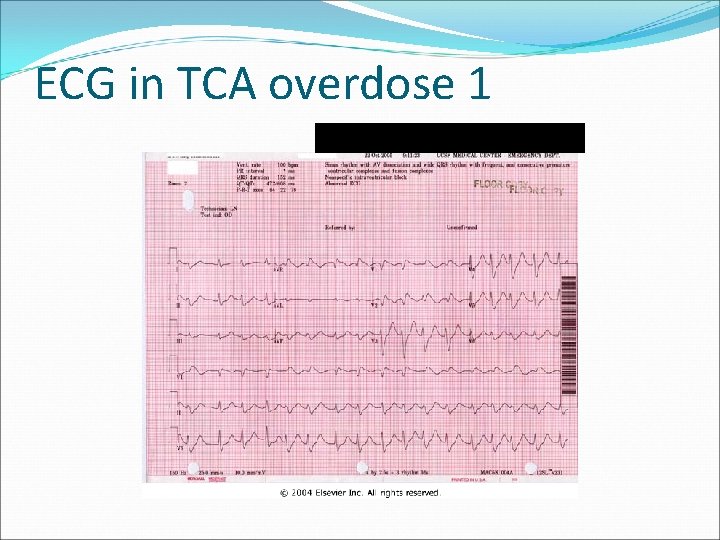 ECG in TCA overdose 1 