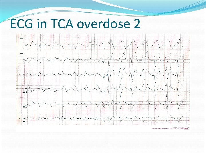 ECG in TCA overdose 2 