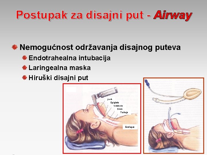 Postupak za disajni put - Airway Nemogućnost održavanja disajnog puteva Endotrahealna intubacija Laringealna maska