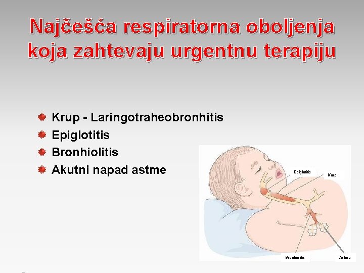 Najčešća respiratorna oboljenja koja zahtevaju urgentnu terapiju Krup - Laringotraheobronhitis Epiglotitis Bronhiolitis Akutni napad Najčešća respiratorna oboljenja koja zahtevaju urgentnu terapiju Krup - Laringotraheobronhitis Epiglotitis Bronhiolitis Akutni napad