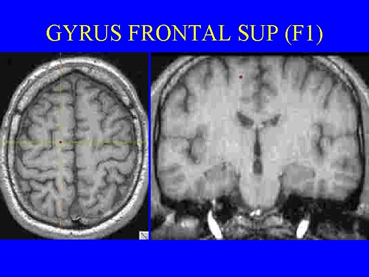 GYRUS FRONTAL SUP (F 1) 