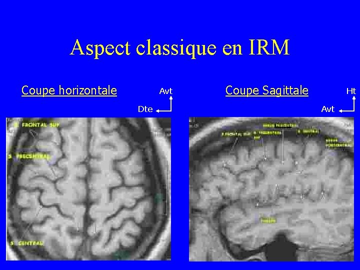 Aspect classique en IRM Coupe horizontale Avt Dte Coupe Sagittale Ht Avt 