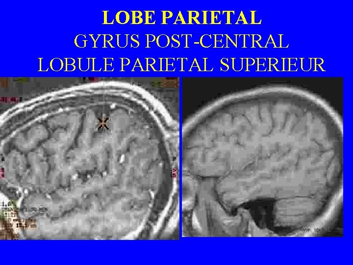 LOBE PARIETAL GYRUS POST-CENTRAL LOBULE PARIETAL SUPERIEUR 