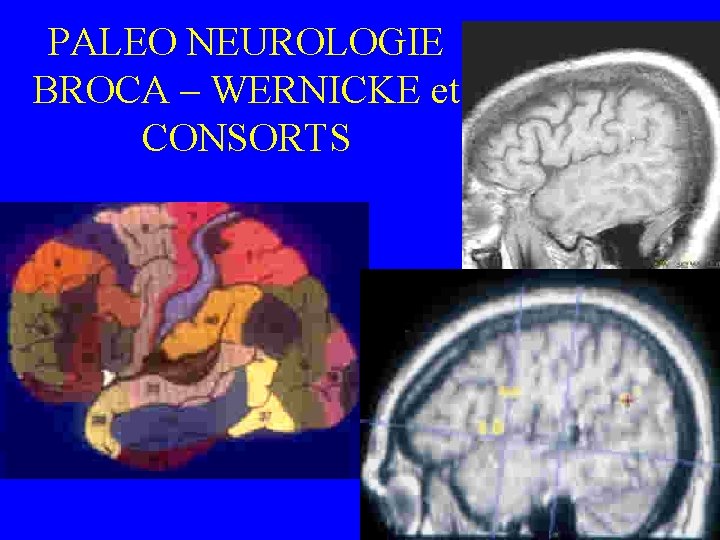 PALEO NEUROLOGIE BROCA – WERNICKE et CONSORTS 