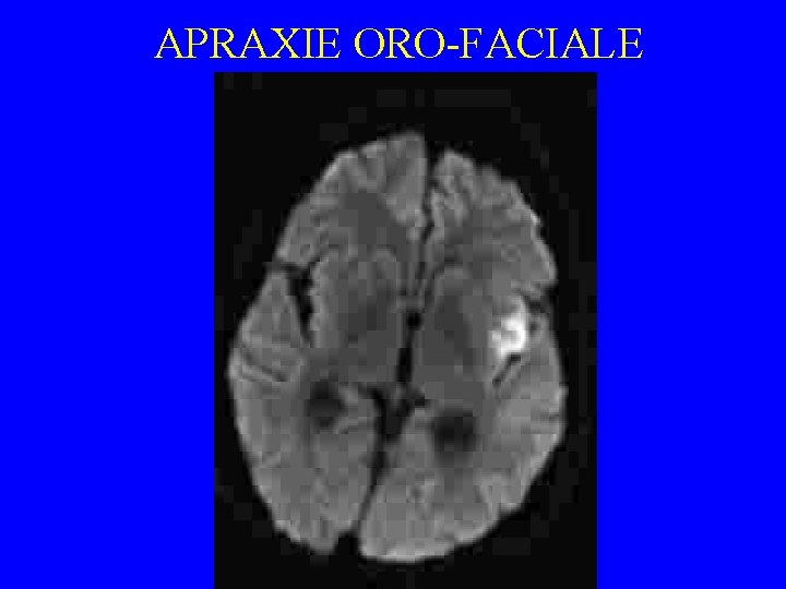 APRAXIE ORO-FACIALE 