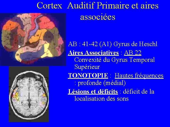 Cortex Auditif Primaire et aires associées AB : 41 -42 (A 1) Gyrus de