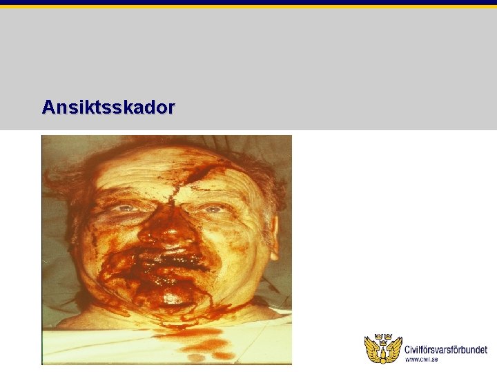 Ansiktsskador 