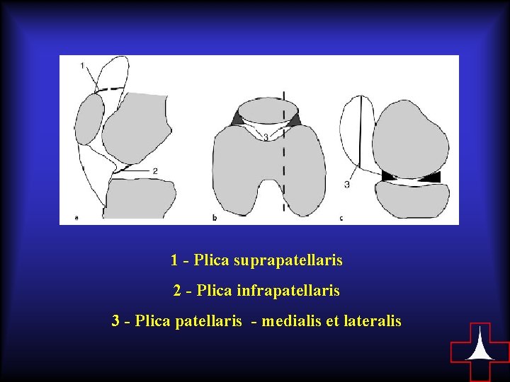 1 - Plica suprapatellaris 2 - Plica infrapatellaris 3 - Plica patellaris - medialis