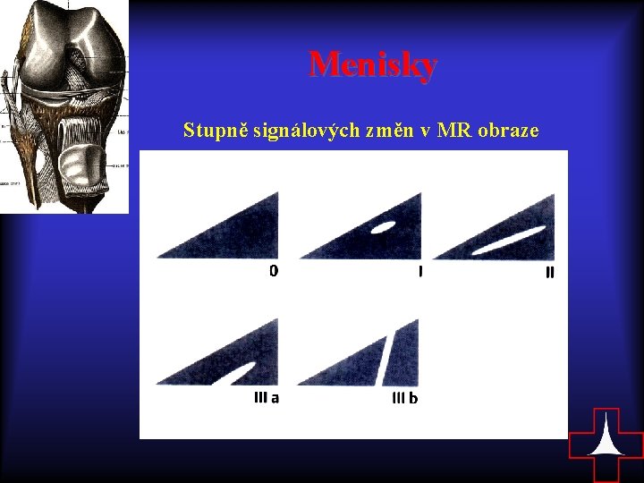 Menisky Stupně signálových změn v MR obraze 
