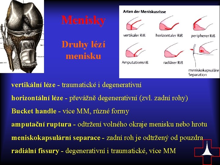 Menisky Druhy lézí menisku vertikální léze - traumatické i degenerativní horizontální léze - převážně