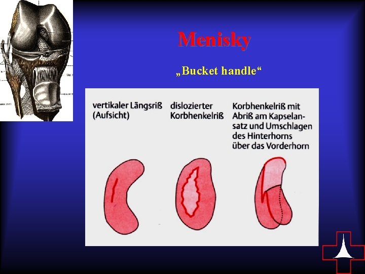 Menisky „Bucket handle“ 