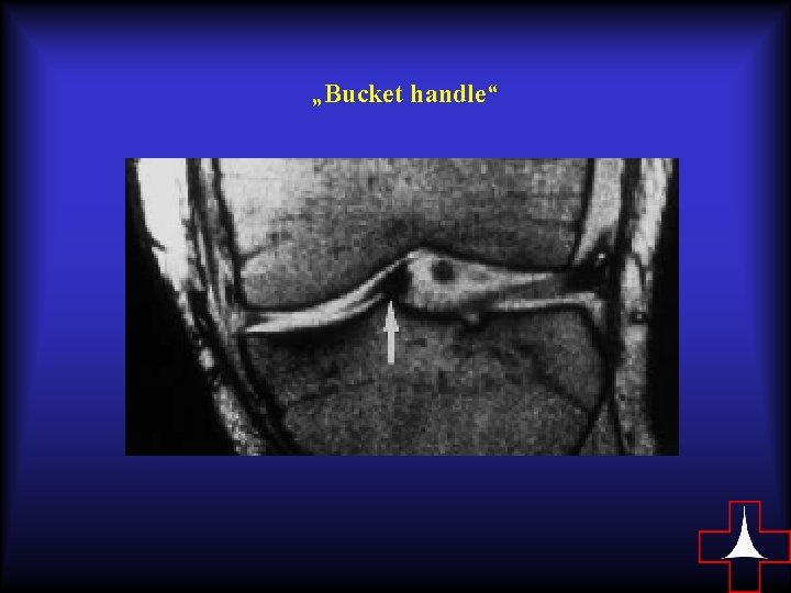 „Bucket handle“ 
