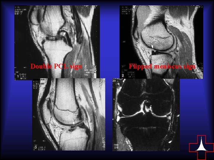 Double PCL sign Flipped meniscus sign 