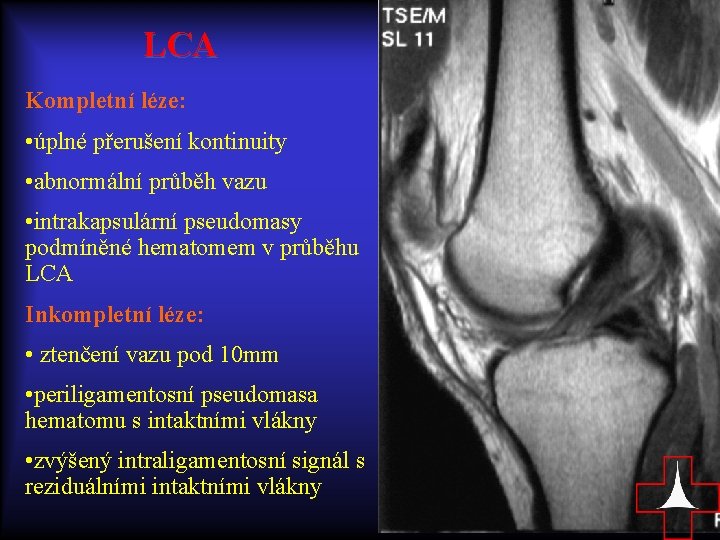 LCA Kompletní léze: • úplné přerušení kontinuity • abnormální průběh vazu • intrakapsulární pseudomasy
