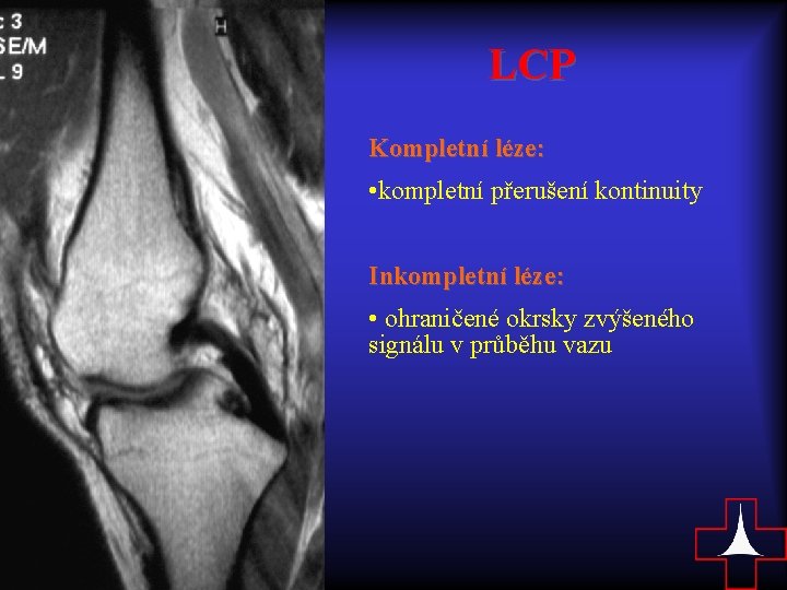 LCP Kompletní léze: • kompletní přerušení kontinuity Inkompletní léze: • ohraničené okrsky zvýšeného signálu