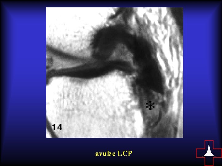 avulze LCP 