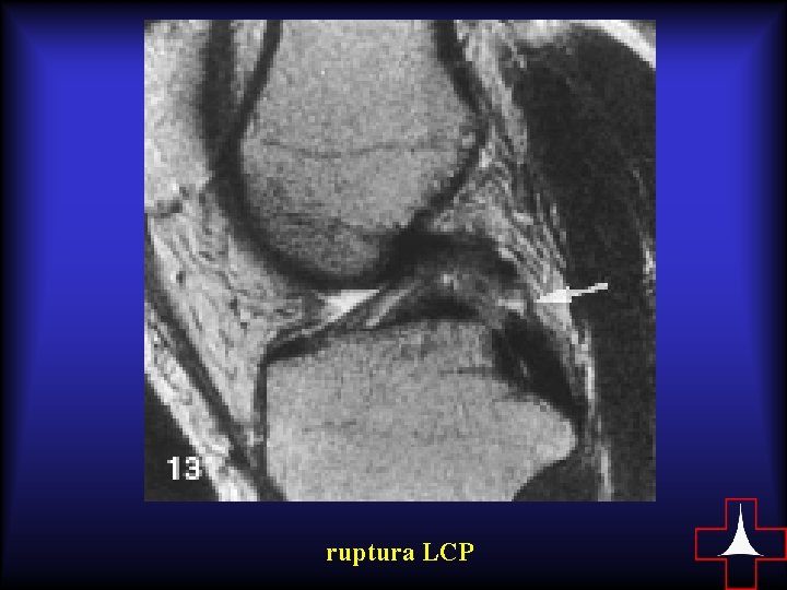 ruptura LCP 
