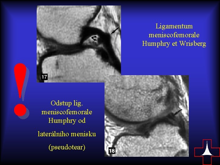 ! Ligamentum meniscofemorale Humphry et Wrisberg Odstup lig. meniscofemorale Humphry od laterálního menisku (pseudotear)