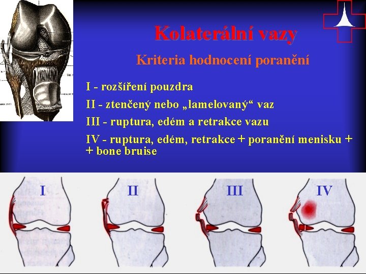 Kolaterální vazy Kriteria hodnocení poranění I - rozšíření pouzdra II - ztenčený nebo „lamelovaný“