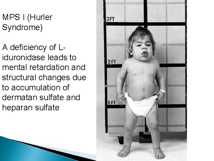 MPS I (Hurler Syndrome) A deficiency of Liduronidase leads to mental retardation and structural