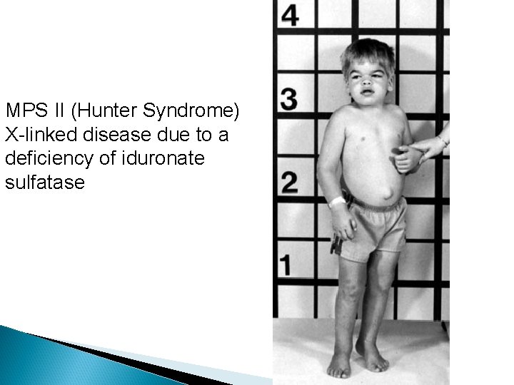 MPS II (Hunter Syndrome) X-linked disease due to a deficiency of iduronate sulfatase 