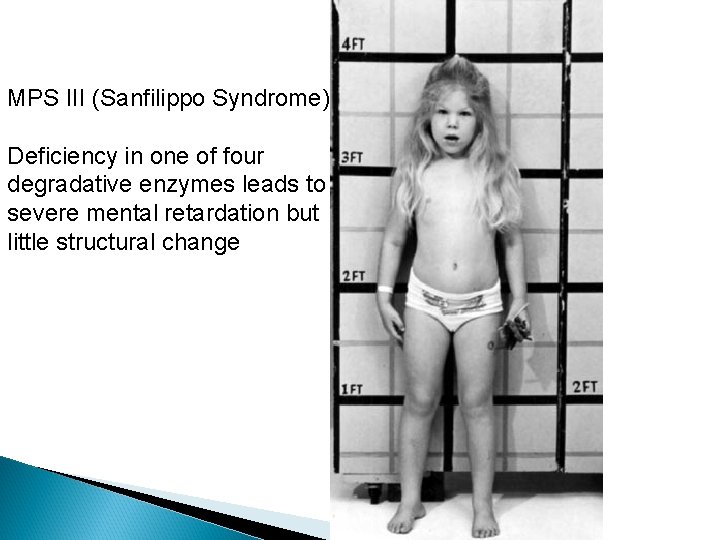 MPS III (Sanfilippo Syndrome) Deficiency in one of four degradative enzymes leads to severe