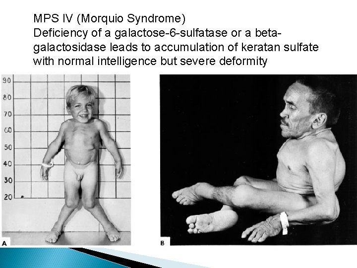 MPS IV (Morquio Syndrome) Deficiency of a galactose-6 -sulfatase or a betagalactosidase leads to