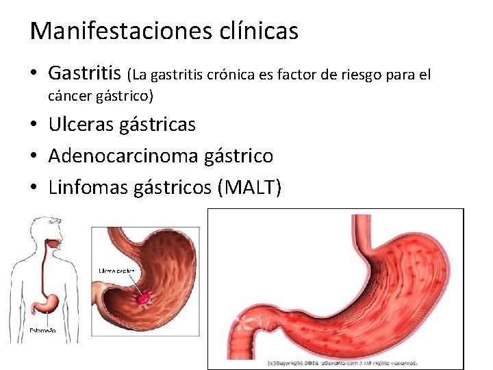 Manifestaciones clínicas • Gastritis (La gastritis crónica es factor de riesgo para el cáncer