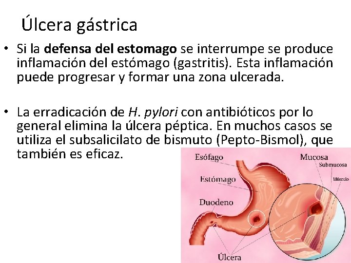 Úlcera gástrica • Si la defensa del estomago se interrumpe se produce inflamación del