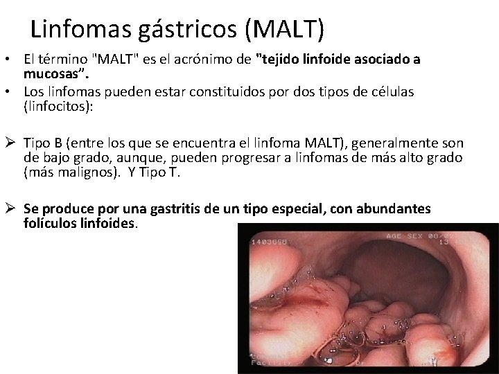 Linfomas gástricos (MALT) • El término "MALT" es el acrónimo de "tejido linfoide asociado