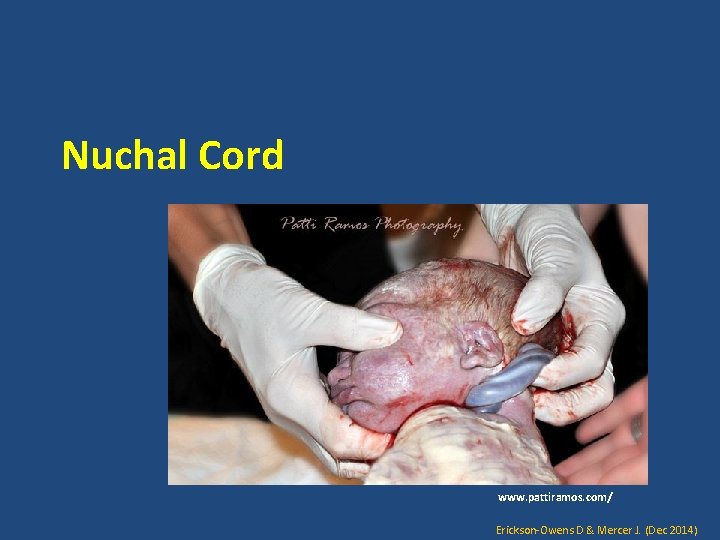 Nuchal Cord www. pattiramos. com/ Erickson-Owens D & Mercer J. (Dec 2014) 