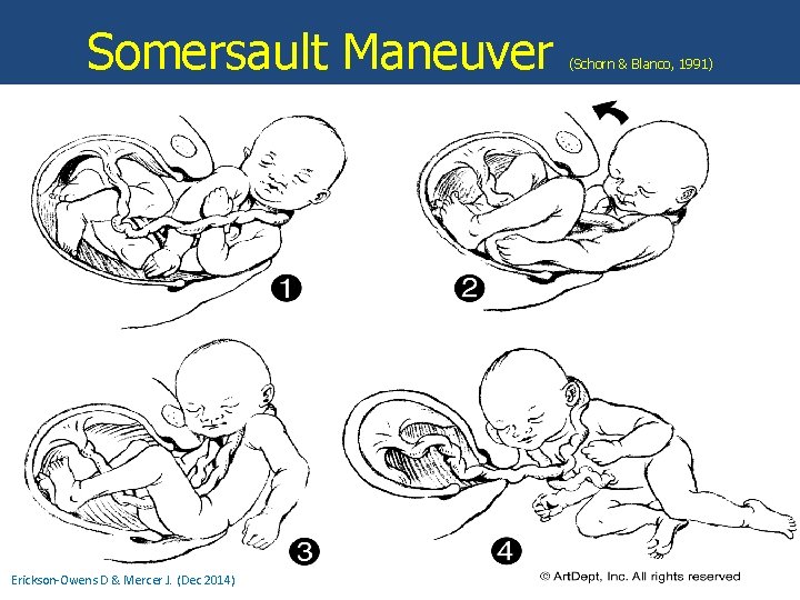 Somersault Maneuver Erickson-Owens D & Mercer J. (Dec 2014) (Schorn & Blanco, 1991) 