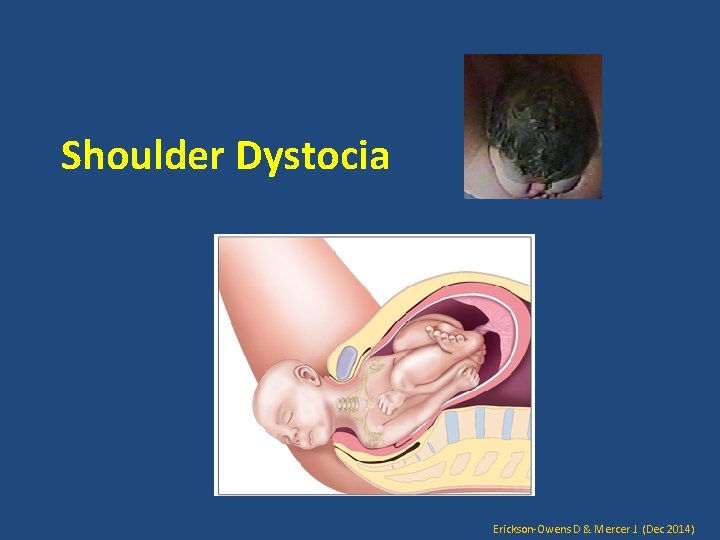 Shoulder Dystocia Erickson-Owens D & Mercer J. (Dec 2014) 