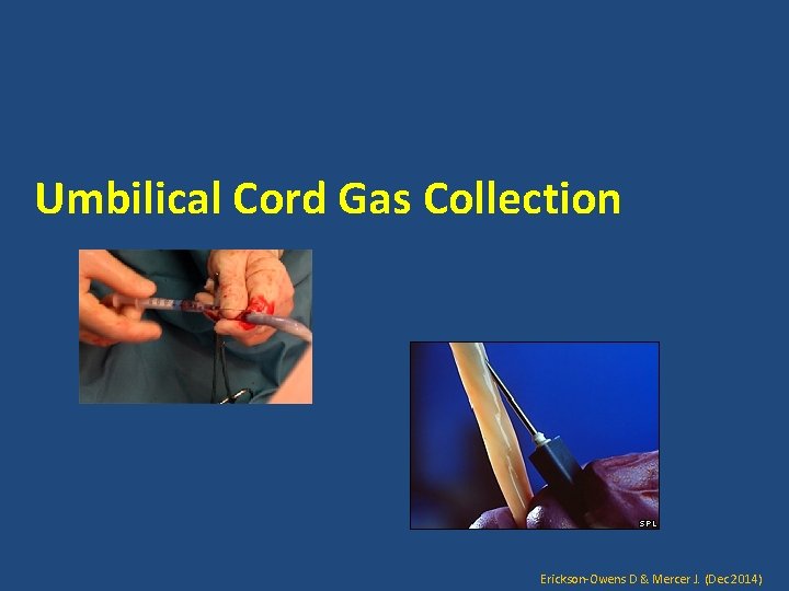 Umbilical Cord Gas Collection Erickson-Owens D & Mercer J. (Dec 2014) 