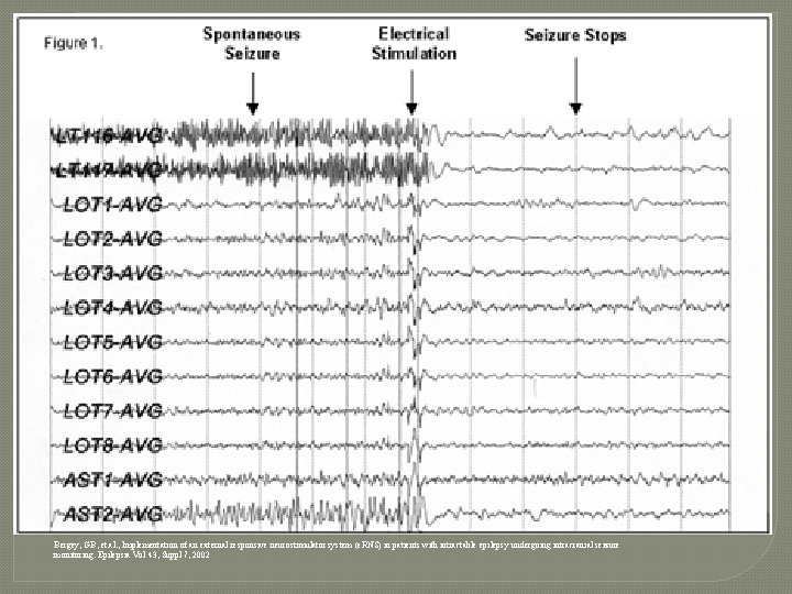 Bergey, GB, et. al. , Implementation of an external responsive neurostimulator system (e. RNS)