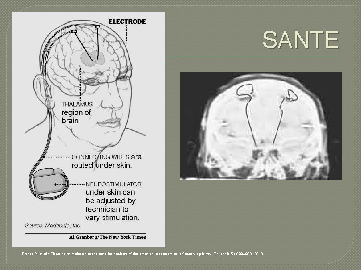SANTE Fisher R, et al. : Electrical stimulation of the anterior nucleus of thalamus