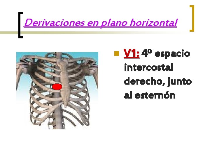 Derivaciones en plano horizontal n V 1: 4º espacio intercostal derecho, junto al esternón