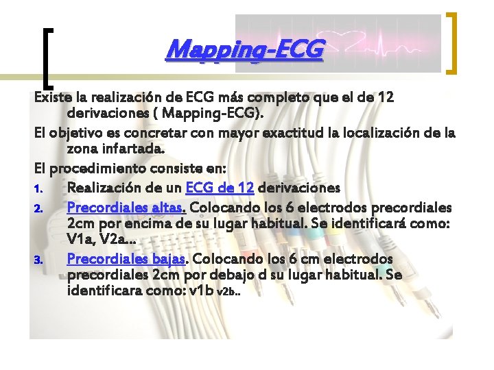 Mapping-ECG Existe la realización de ECG más completo que el de 12 derivaciones (