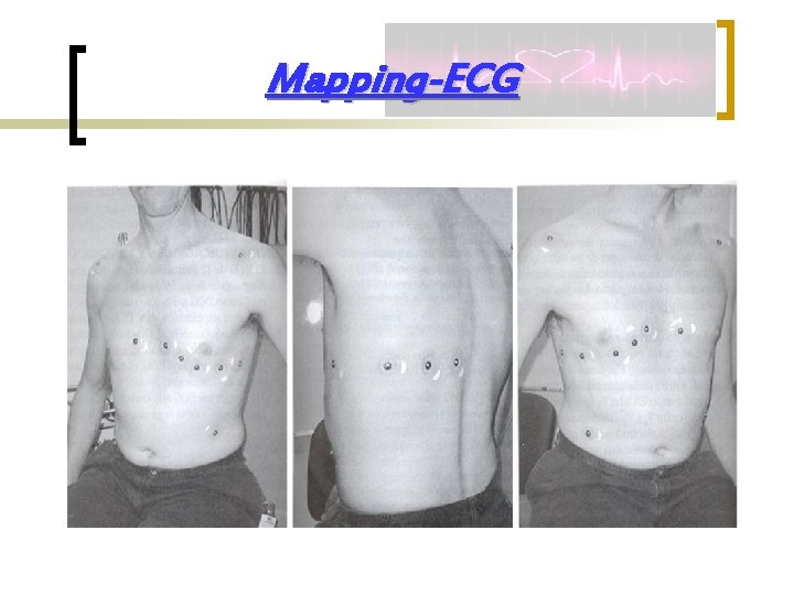 Mapping-ECG 