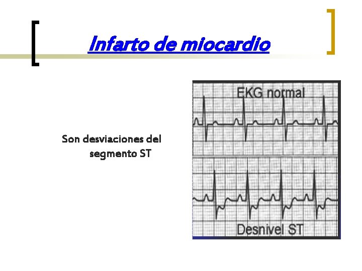 Infarto de miocardio Son desviaciones del segmento ST 