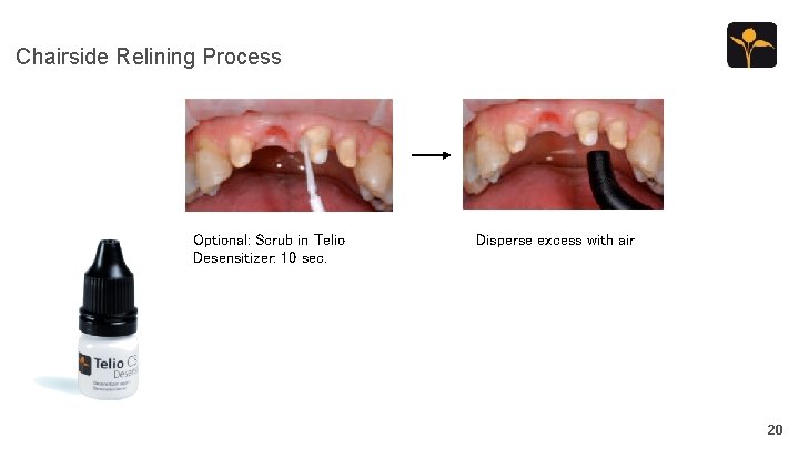 Chairside Relining Process Optional: Scrub in Telio Desensitizer: 10 sec. Disperse excess with air