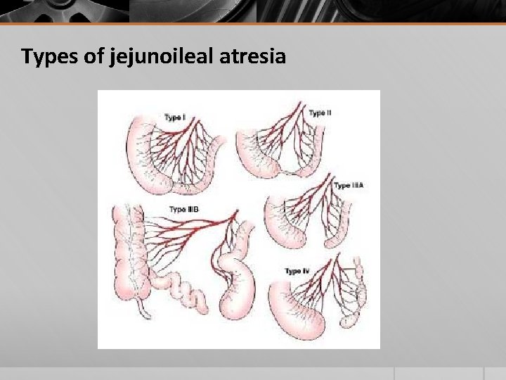 Types of jejunoileal atresia 