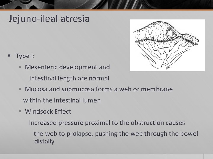 Jejuno-ileal atresia § Type I: § Mesenteric development and intestinal length are normal §