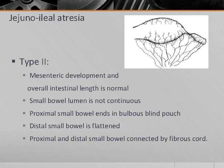 Jejuno-ileal atresia § Type II: § Mesenteric development and overall intestinal length is normal