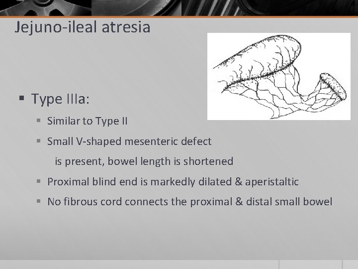Jejuno-ileal atresia § Type IIIa: § Similar to Type II § Small V-shaped mesenteric