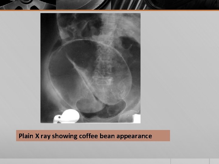 Plain X ray showing coffee bean appearance 