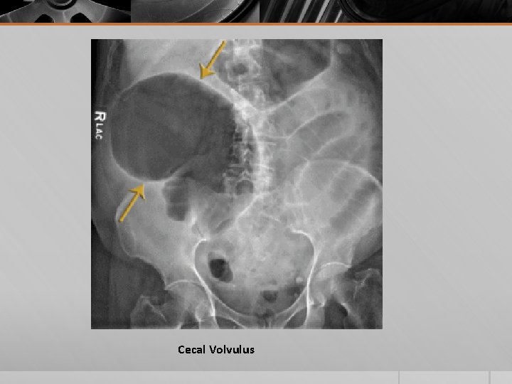 Cecal Volvulus 