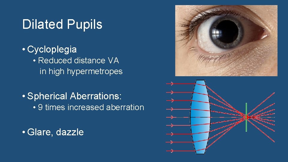 Dilated Pupils • Cycloplegia • Reduced distance VA in high hypermetropes • Spherical Aberrations: