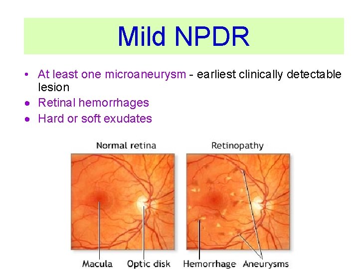 Mild NPDR • At least one microaneurysm - earliest clinically detectable lesion Retinal hemorrhages